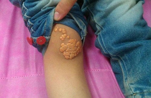 A Child's leg with Xanthoma caused from FH