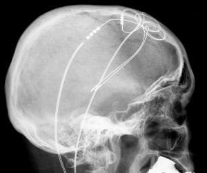 xray of head with deep brain stimulation wires
