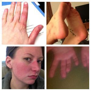 4 images; hand with red index finger; feet with spots; flushing face; swollen hands