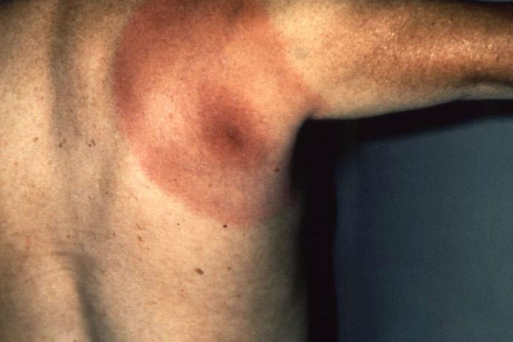 Are People With Lyme Disease Doomed?