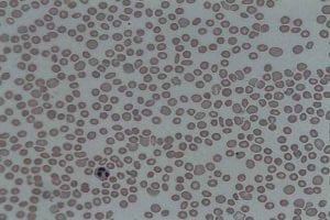 What You Need to Know About Low Thrombocytes