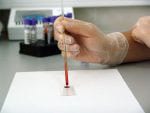 Cosibelimab Beneficial for cSCC, Research Shows