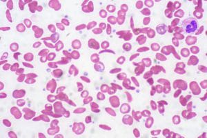 sickle cell anemia platelets