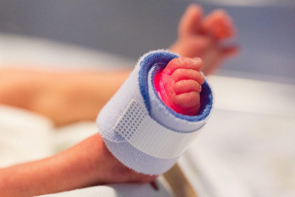 Gastroschisis Baby Wrapped In Plastic To Save Her Life
