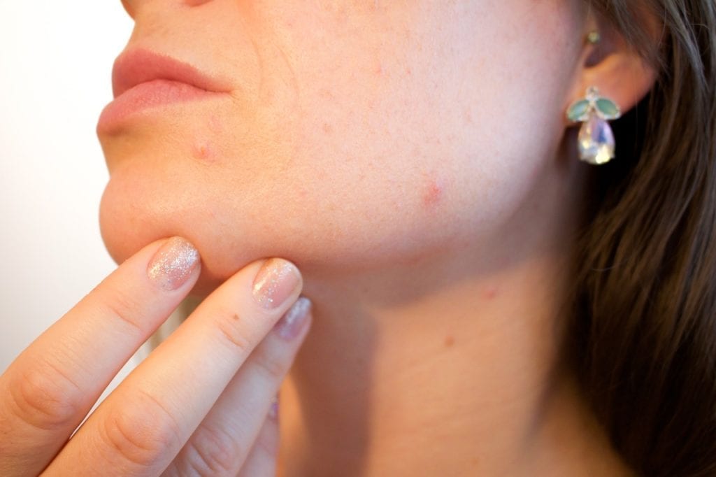 Could Acne Cause Sarcoidosis?