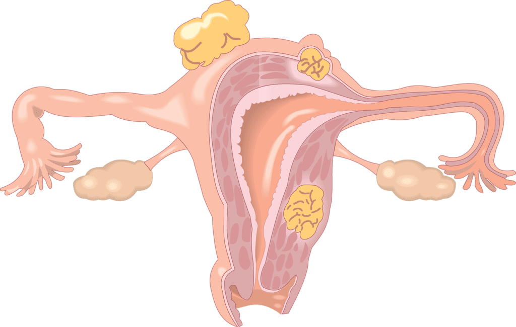 Final Trial Data Available on MVP-S for Ovarian Cancer