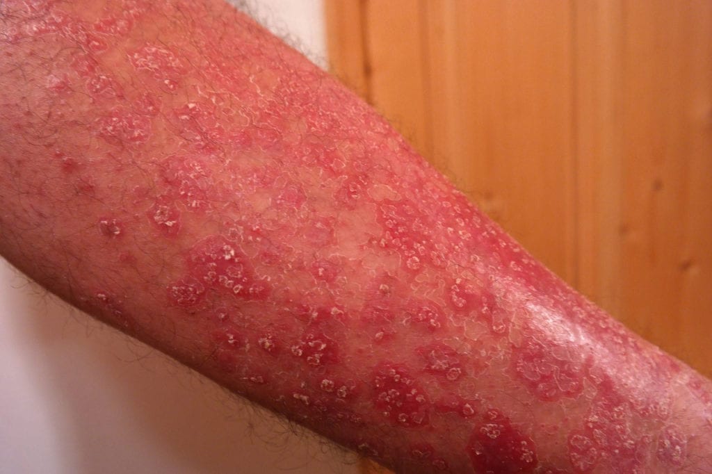 Psoriasis Drug Now a Potential Candidate to Treat PsA and Uveitis