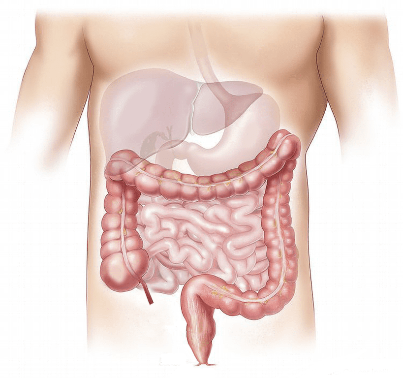 Severe Inflammatory Bowel Disease Increases The Risk of Non-Alcoholic Fatty Liver Disease, New Research Suggests