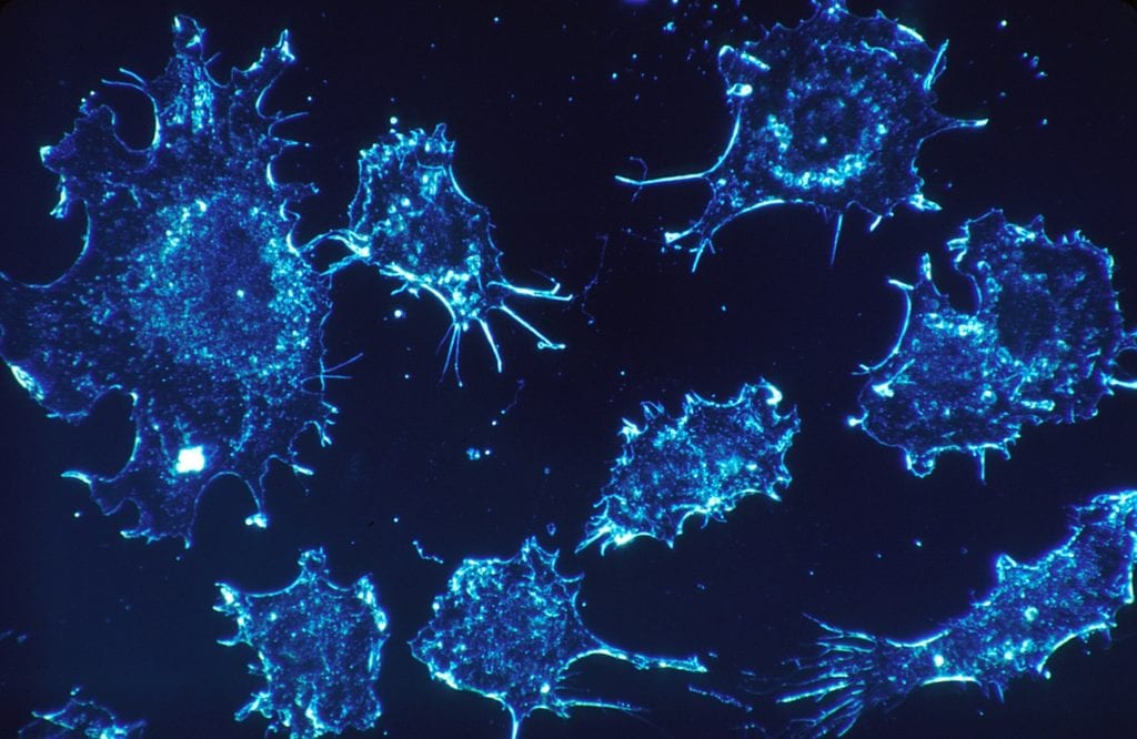 Изменение рН Баланса Может Убить Раковые Клетки Поджелудочной Железы