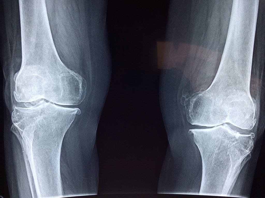 Risk of Amputation in Osteomyelitis Linked to Burden of Comorbidities