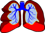 Unique Class of Drugs Shows Potential in Treating Idiopathic Pulmonary Fibrosis