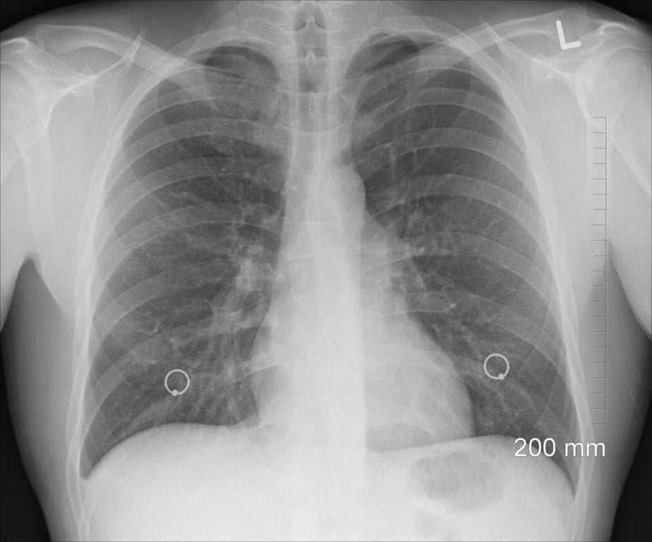 Pulmonary Hypertension Drugs are Effective for Some Sarcoidosis Patients, Study Says