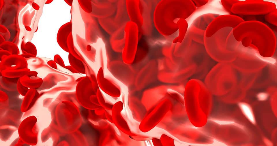 What is the Cost of Living with Sickle Cell Disease?