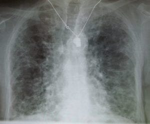 Lungs of patient with idiopathic pulmonary fibrosis (IPF)