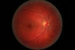 Study: Visual Hallucinations in Parkinson’s Patients and Retinal Thinning