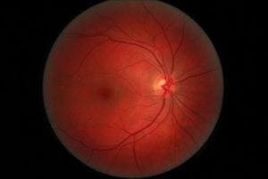 Right eye retina can help scan for multiple sclerosis