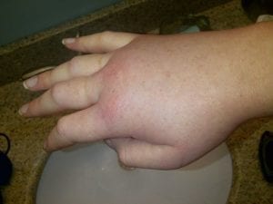 Hand swollen during hereditary angioedema attack