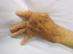 Hand with severe rheumatoid arthritis