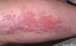 IVIG Improved Dermatomyositis Symptoms, Study Says