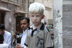 Boy with albinism