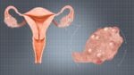 New Study Suggests 2 Gene-Based Subtypes of Polycystic Ovarian Syndrome