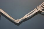 Study Finds New Therapy to be Efficacious for Rheumatoid Arthritis Patients Unresponsive to Methotrexate