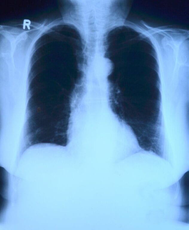 September is Pulmonary Fibrosis Awareness Month: Spreading Rare Disease Awareness