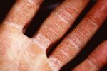 SHR0302 Helps Clear Severe AD, Study Says