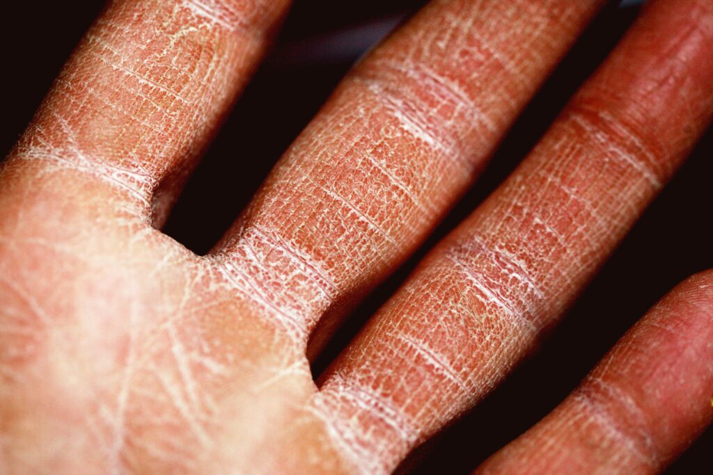 SHR0302 aide à éliminer la dermatite atopique sévère, selon une étude