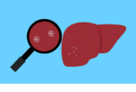 Bylvay Now Approved for Cholestatic Pruritus Caused by Alagille Syndrome in Patients Aged 1+ 