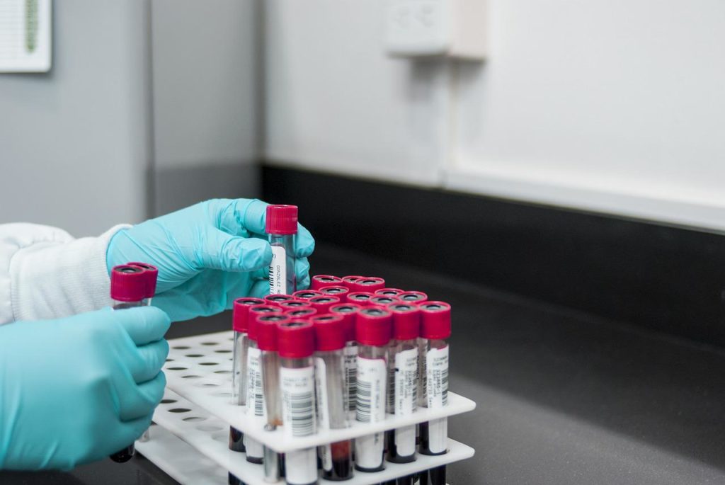 A Novel Blood Test Has Been Developed to Assess Pancreatic Cancer Risk