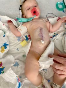 Surgery to fix the omphalocele