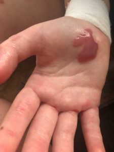 Patterson's palm blister from epidermolysis bullosa