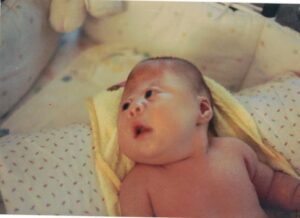 Laura, who has Carpenter syndrome, as a baby before she got craniofacial surgery. 