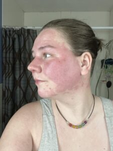 Kyla with the red rash caused by her Gleich syndrome