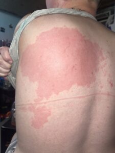 A red, splotchy back rash due to Gleich syndrome. The rash looks like a large, circular welt with jagged edges. It takes over about 1/4 of the back.