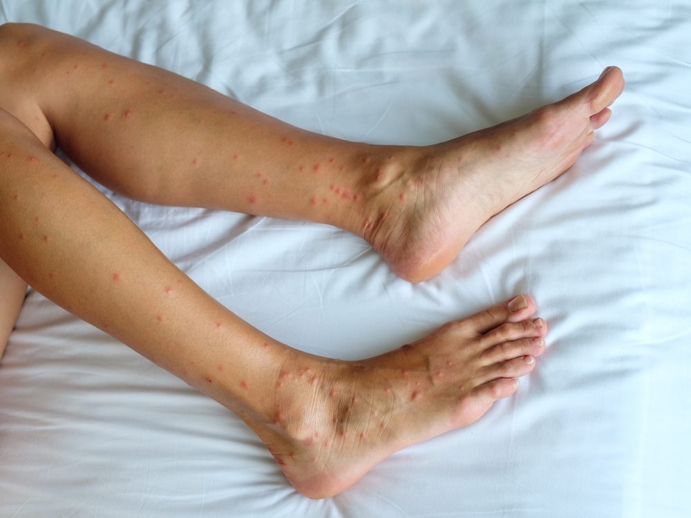 Pyemotes Ventricosus Dermatitis: A Rare Condition Caused by Mites in Furniture