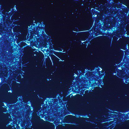 Hairy Cell Leukemia: Drug Combo Achieves Significant Remissions