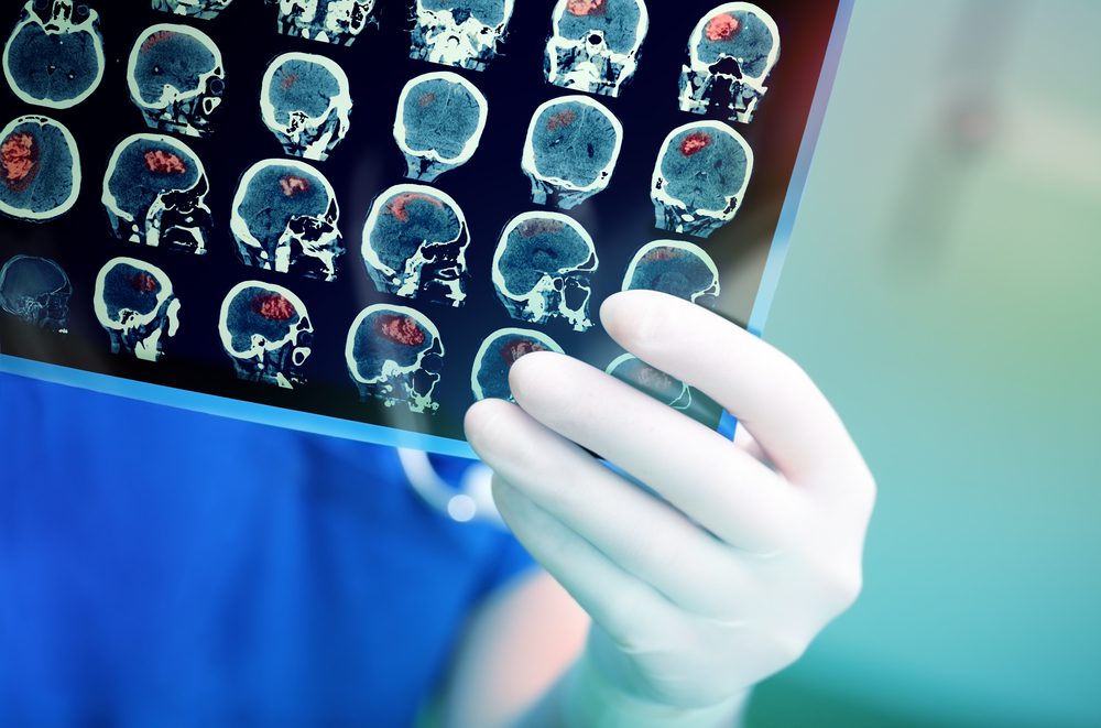Experimental Treatment Shows Promise in Diffuse Midline Glioma