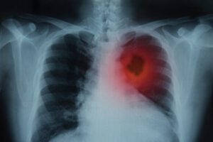 Adagrasib Shows Promise in Treating KRAS G12C-Mutated NSCLC