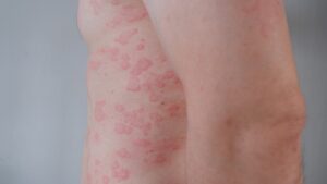 Experimental Drug Shows Promise in Prurigo Nodularis and Chronic Spontaneous Urticaria