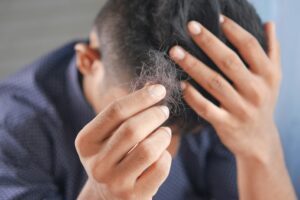 Alopecia areata causes patchy hair loss. In this photo, someone sits with their hand on their hair and holds up loose hair to the camera.