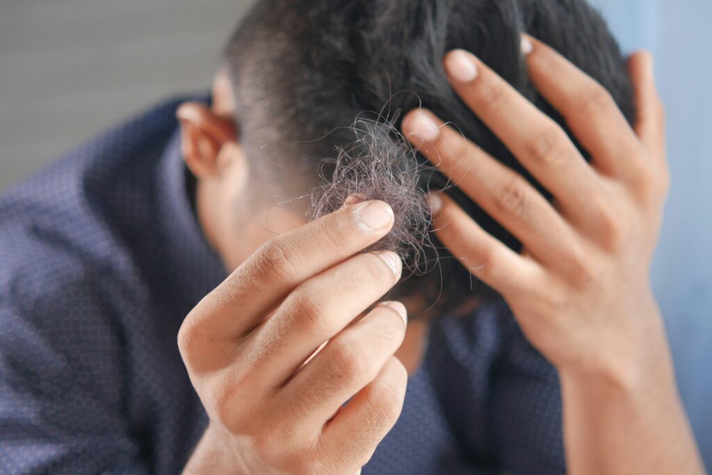 Fewer than 33% of People with Alopecia Areata Attend Support Groups