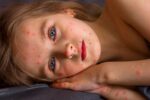 Enveda’s Oral Candidate ENV-294 Shows Early Promise in Atopic Dermatitis