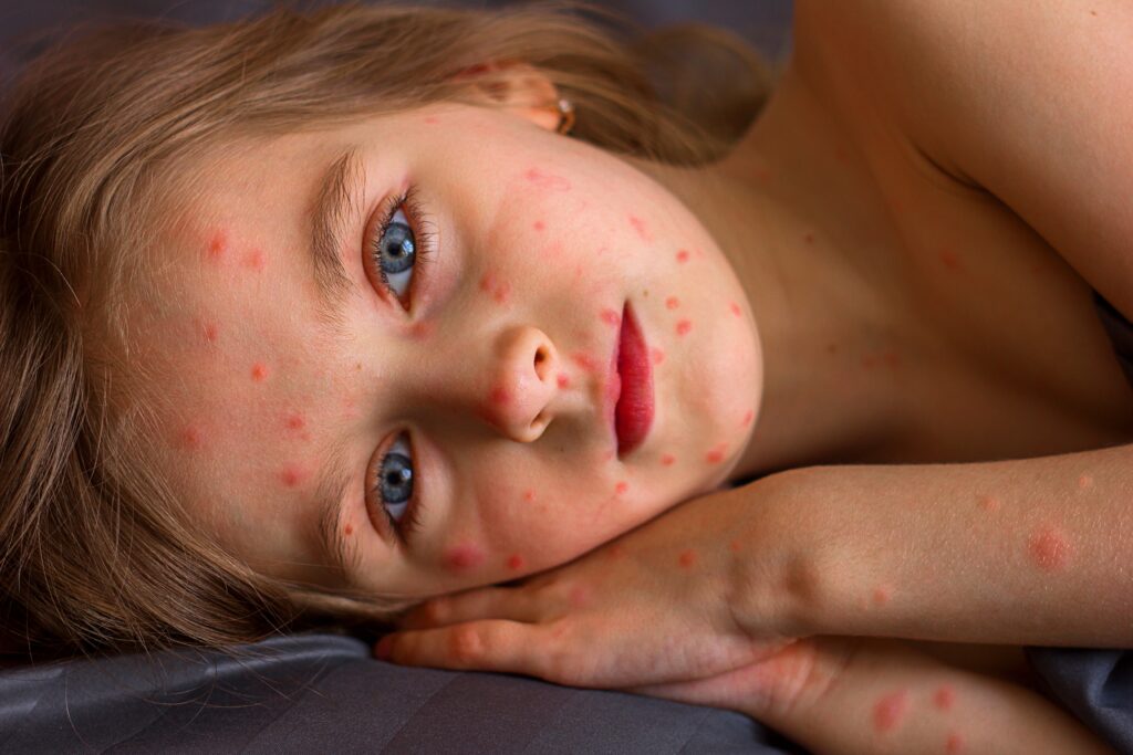 Measles outbreaks double in Texas and New Mexico