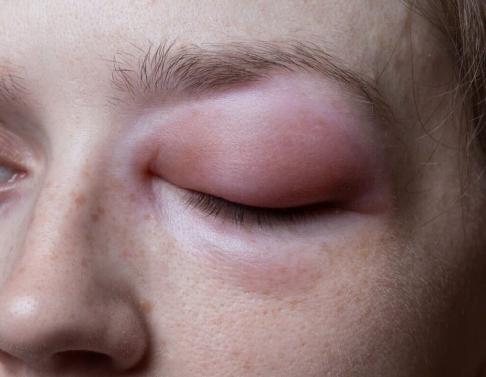 The US FDA has Approved Andembry for Prevention of HAE Attacks