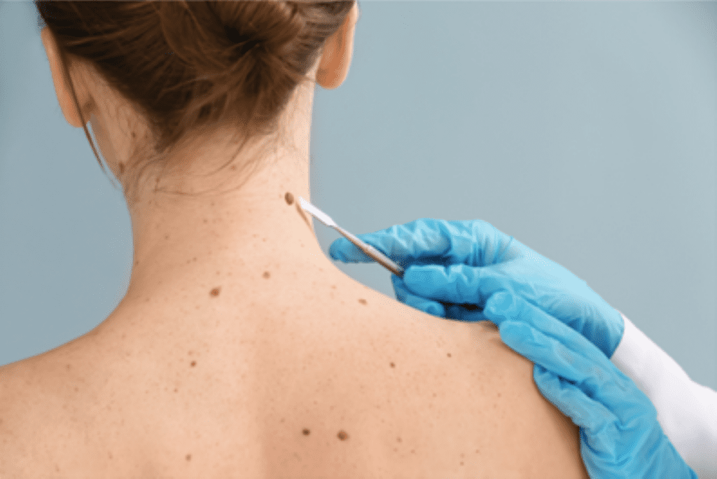 ScanCell’s Skin Cancer Vaccine Shows Phase 2 Promise, but Only One Candidate Moves Forward