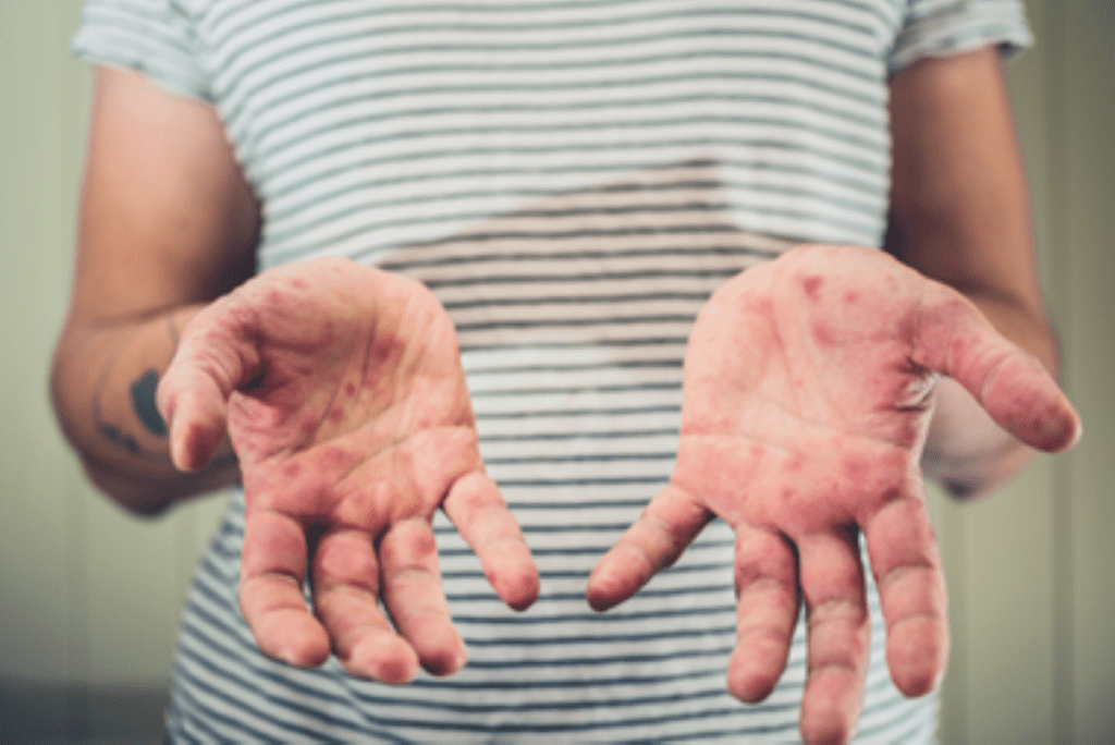 US Measles Cases Surge Amid Vaccine Hesitancy and Political Debate