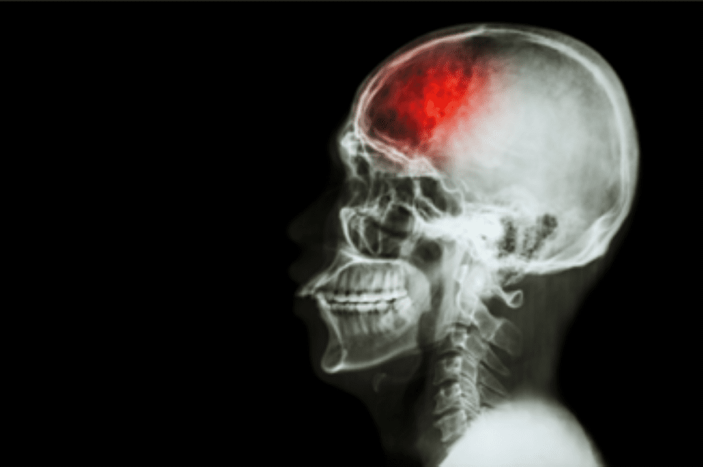 New Therapy Shows Promise in Reducing Stroke-Induced Brain Damage in Mice
