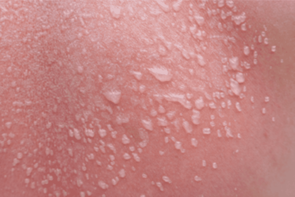 A New Era for Fragile Skin: How Gene Therapy is Transforming Rare Skin Diseases